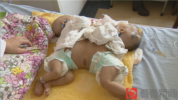 三维技术帮助精准分离 江西联体男婴成功手术
