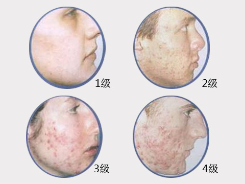 痤疮好发于面部及上胸背部,其非炎症性皮损表现为开放性和闭合性粉刺