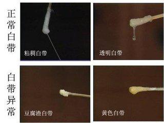 一般说来,正常的白带应该是乳白色或