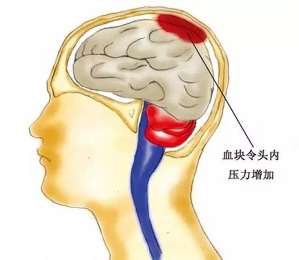 脑出血 | 窗口期内辅助清除血肿