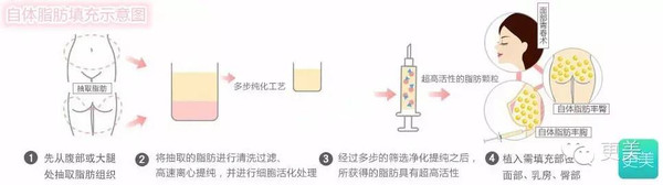 史上最全自体脂肪隆胸大揭秘