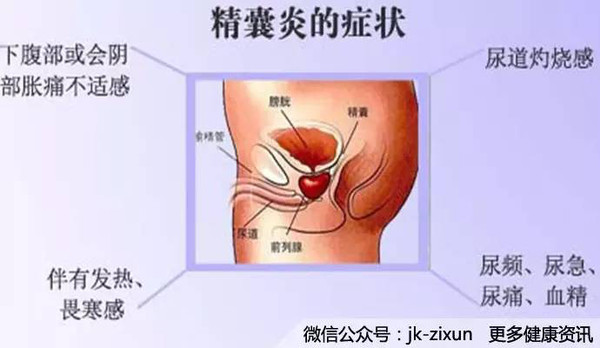 精囊炎的症状