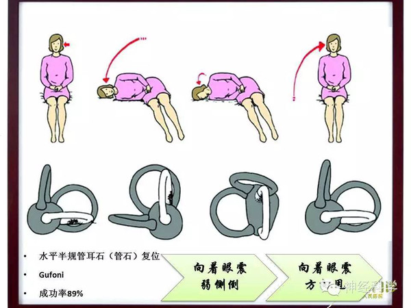 【长安眩晕讲堂精品课件】良性阵发性位置性眩晕