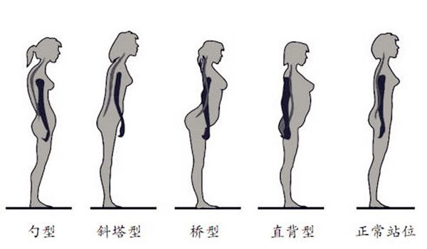 因为后背呈拱形,腰椎的负担非常大; "勺形"则是第三大不良站姿,后背