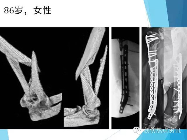 【组图】单侧双钢板治疗远1/3肱骨干骨折