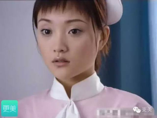 示范明星——变美前的李小璐 解决方案1分段式假体隆鼻——鼻背用i型