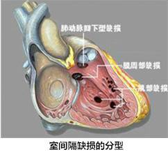 专病疗小儿先心脏中病室间隔缺损占首位天使微尘基金有援助