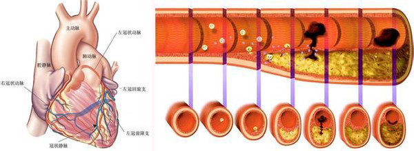 冠状动脉微血管病变.ppt