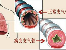 针对慢性支气管炎的日常生活护理事项