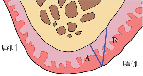 口腔种植手术学图解组织切口与瓣的设计
