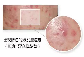 Ⅲ度 ——脓包 样子看图片,挤出来的是白色小米粒一样的东东.