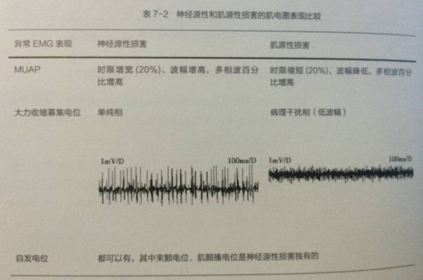 图7-2 运动单位动作电位(干扰相) 常规肌电图主要用于诊断及鉴别神经