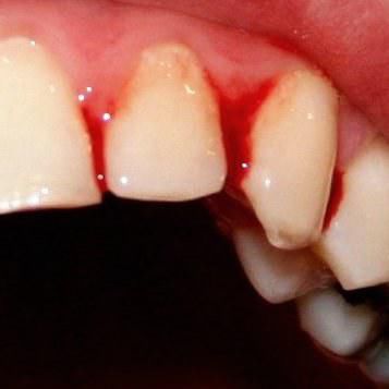 这不但不能清除牙齿的菌斑,还会卡在牙齿间非常痛,这可能导致牙龈出血