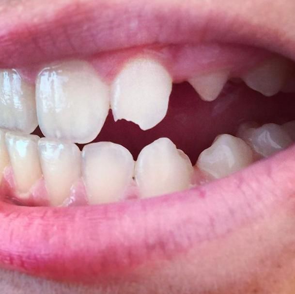 11.在牙齿上有一个裂缝或者缺口,不管多么小都会特别容易导致蛀牙