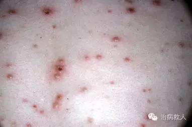 临床必知?|?水痘诊疗八问答!,打水痘疫苗不能吃什么,水痘疫苗什么时候打最好,水痘疫苗有效期多久,水痘疫苗最佳接种时间,