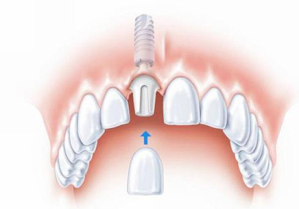 但如因疾病或意外失去了牙齿,那么在各种修复方法中,种植牙应是最佳的