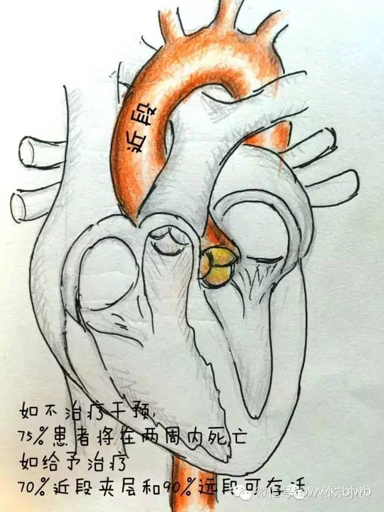 "被石子颠了一下后,她突然感到剧烈胸痛,到医院一查,主动脉夹层,"这叫