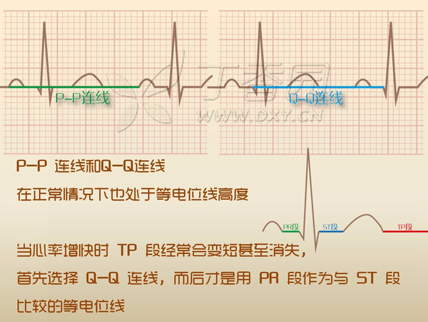 段作为心电图中十分重要的一段,其判断流程分为四步:    确定等电位线