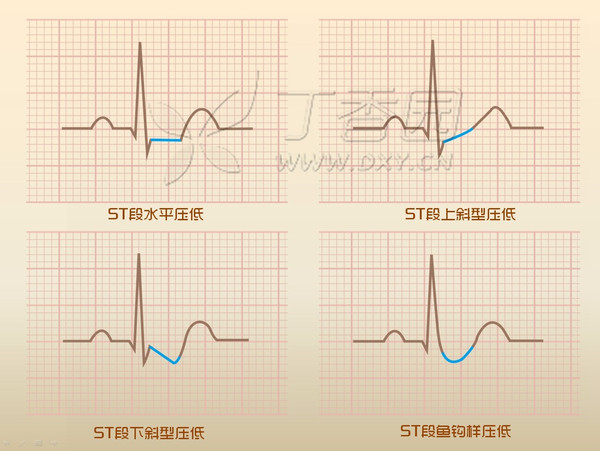 心电图02st02段读图四步法