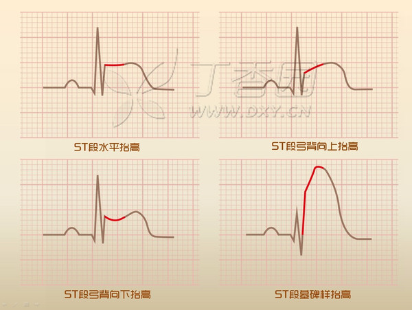 心电图 st 段读图四步法