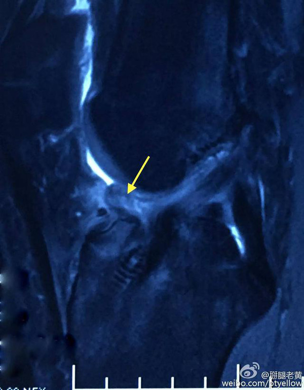 前交叉韧带重建术后为什么要练习伸膝?