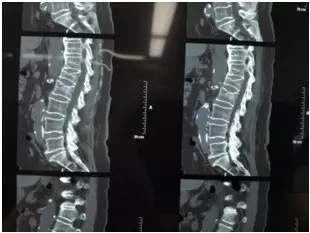 腰椎压缩性骨折的手术治疗:经皮椎体后凸成形