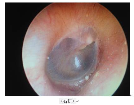 耳内镜检查结果如下图所示:   右耳鼓膜形态正常;左耳鼓膜充血