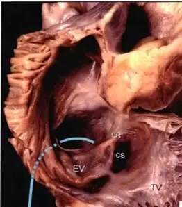 =三尖瓣 下图(a)可以看到,ev的游离缘todaro肌腱走行在er肌样结构中