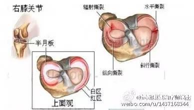 半月板手术后遗症