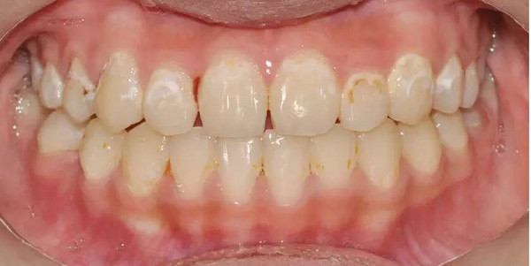 在正畸治疗后,50~80%的患者存在不同程度的牙釉质脱矿[3(图1.