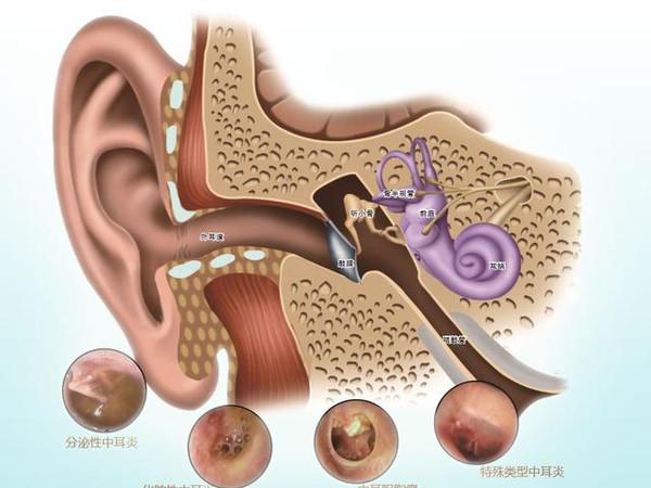 儿童缘何易患分泌性中耳炎?