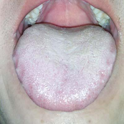 感冒舌苔厚白是哪种类型感冒