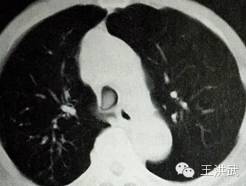 解析丨老年慢性支气管炎和气管肿瘤易混淆