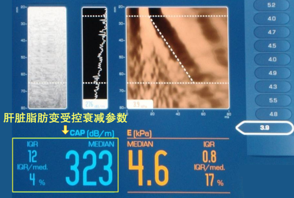 如何利用"飞波"检查脂肪肝?