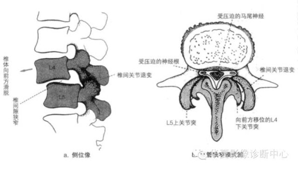 照片显示的是哪一侧的椎弓峡部