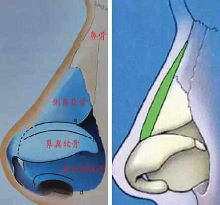 图解详示各种鼻整形方法及过程