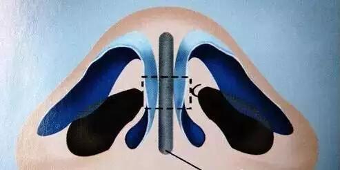 图解详示各种鼻整形方法及过程