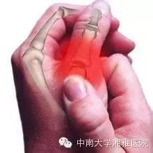 腱鞘炎分为两类,一是桡骨茎突狭窄性腱鞘炎,就是  大拇指与手腕4 得了