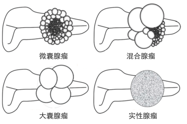 实性囊腺瘤:小囊肿伴厚壁的纤维分隔,中央包裹的小管,基本无腔结构.