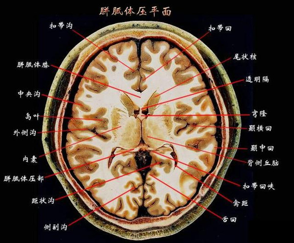 经胼胝体穹隆间入路,由于分开透明隔间腔,不切开侧脑室壁,不暴露丘脑