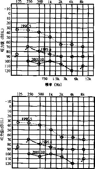 图1病例1不同时间的纯音测听图