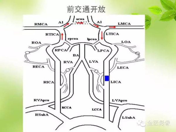 干华:脑侧支循环影像评估及临床意义