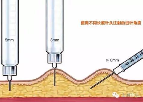 根据胰岛素注射笔用针头的长度明确是否捏皮及进针的角 ..