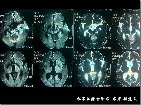 军医科普松果体及松果体瘤