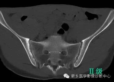 强直性脊柱炎骶髂关节改变分级及图解