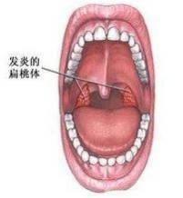 教你如何建立快捷的"咽部不适"诊断思路