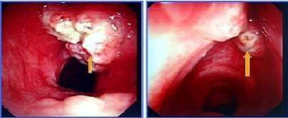 喉癌图片