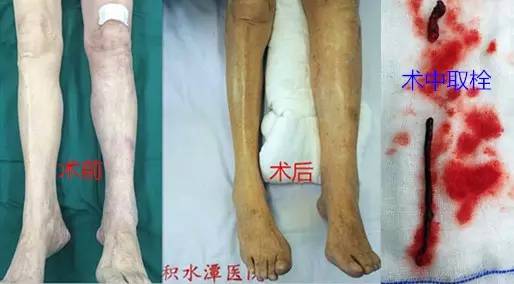 张奶奶术前术后下肢对比及取出的血栓