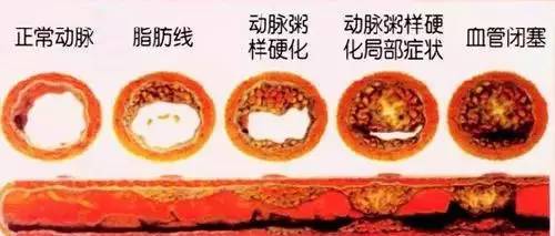 答:心血管堵塞大部分成因都是饮食造成的,因此只有通过饮食调节才能