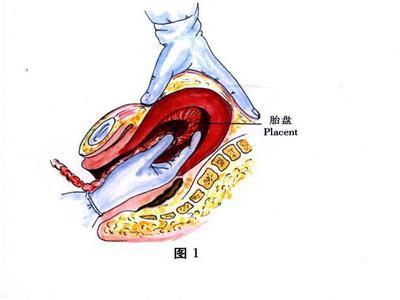 住院患者中有一位因两次引产失败至胎盘粘连及产后出血的患者,这让